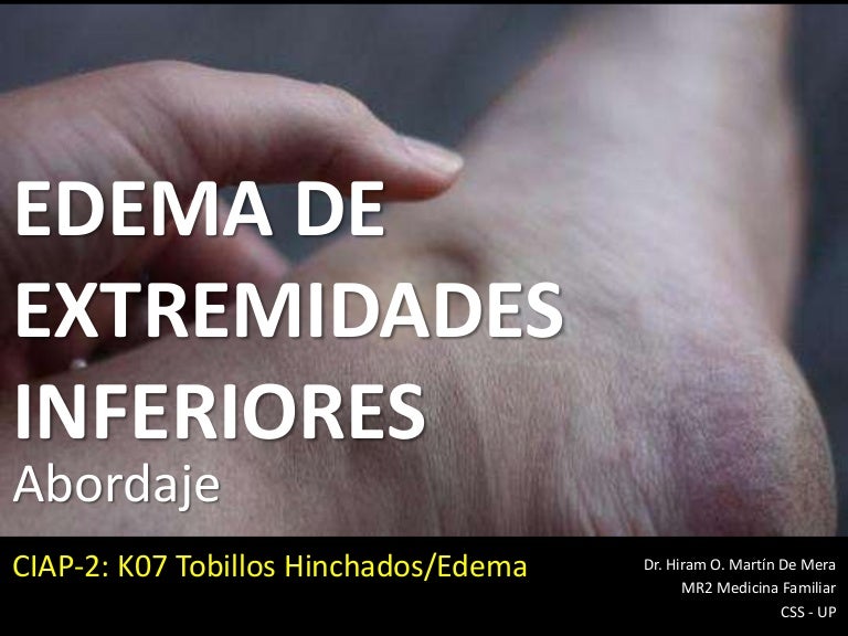 Edema en los pies con dolor Edema en los pies con dolor